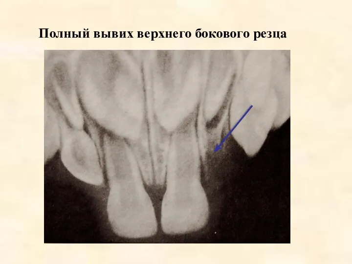 Полный вывих верхнего бокового резца