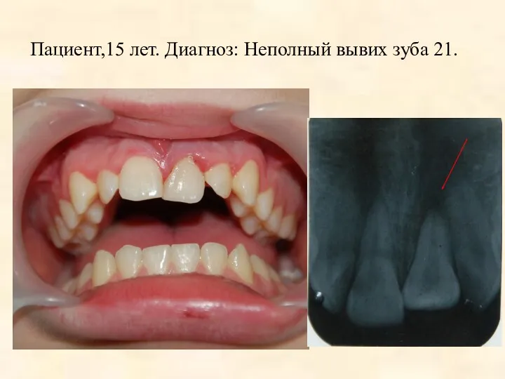 Пациент,15 лет. Диагноз: Неполный вывих зуба 21.