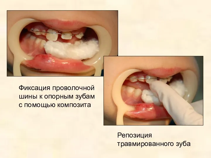 Фиксация проволочной шины к опорным зубам с помощью композита Репозиция травмированного зуба