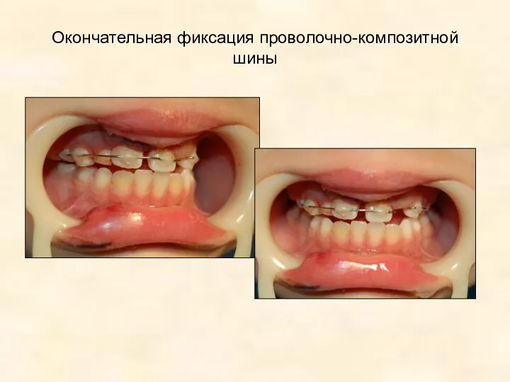 Окончательная фиксация проволочно-композитной шины