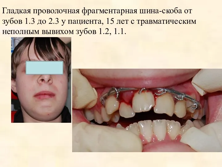 Гладкая проволочная фрагментарная шина-скоба от зубов 1.3 до 2.3 у