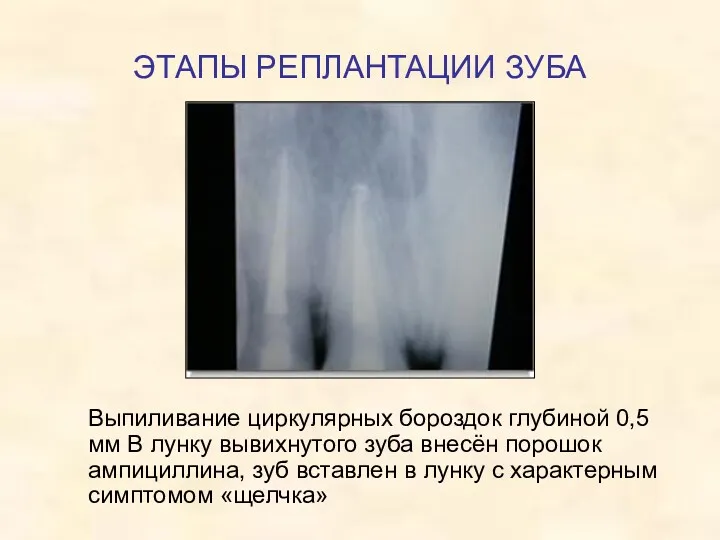 ЭТАПЫ РЕПЛАНТАЦИИ ЗУБА Выпиливание циркулярных бороздок глубиной 0,5 мм В