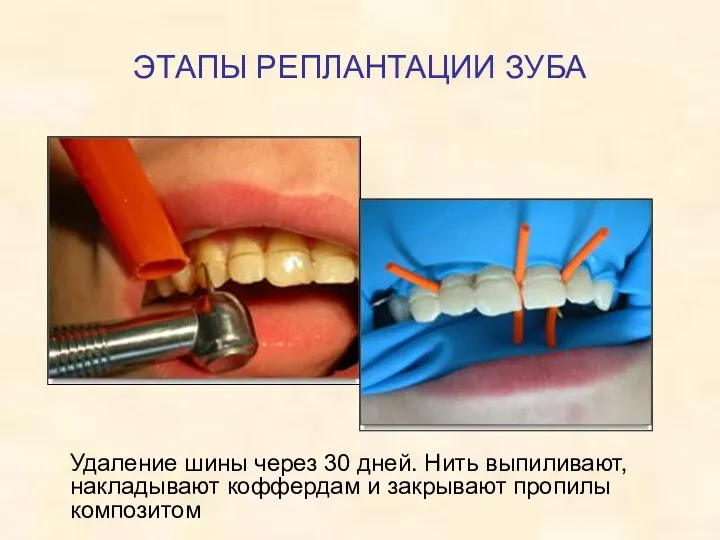 ЭТАПЫ РЕПЛАНТАЦИИ ЗУБА Удаление шины через 30 дней. Нить выпиливают, накладывают коффердам и закрывают пропилы композитом