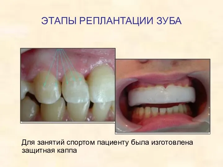 ЭТАПЫ РЕПЛАНТАЦИИ ЗУБА Для занятий спортом пациенту была изготовлена защитная каппа