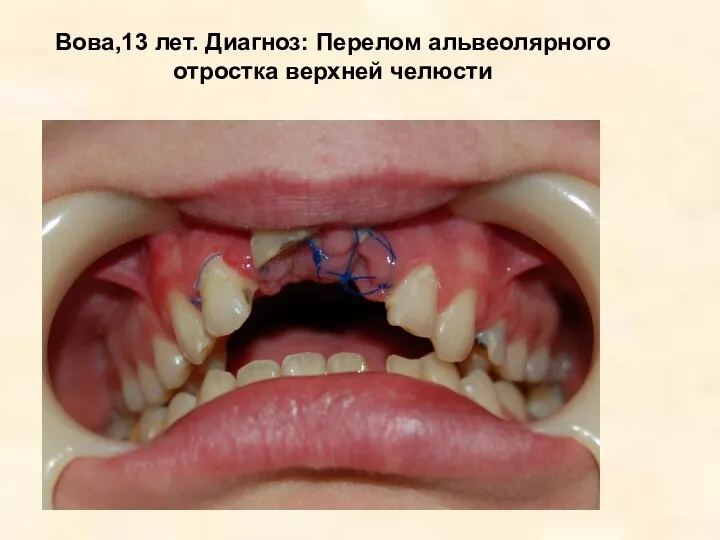 Вова,13 лет. Диагноз: Перелом альвеолярного отростка верхней челюсти