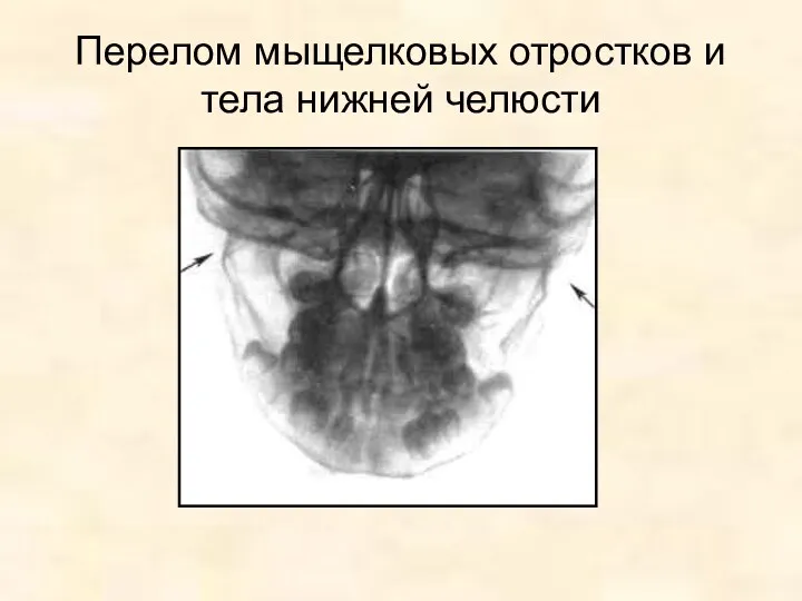 Перелом мыщелковых отростков и тела нижней челюсти