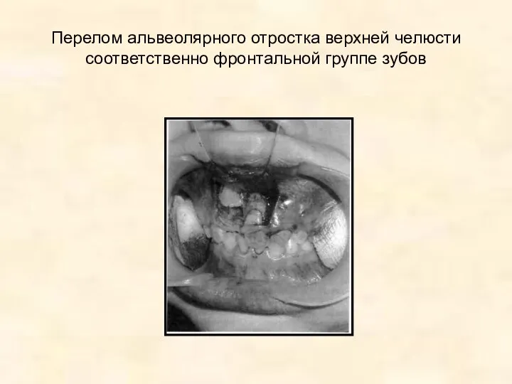 Перелом альвеолярного отростка верхней челюсти соответственно фронтальной группе зубов