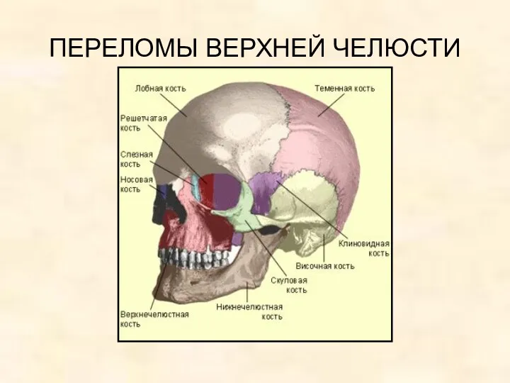 ПЕРЕЛОМЫ ВЕРХНЕЙ ЧЕЛЮСТИ