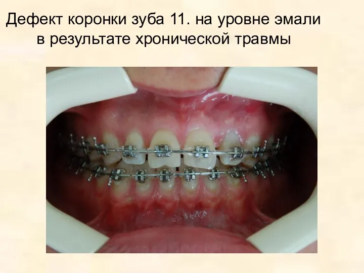 Дефект коронки зуба 11. на уровне эмали в результате хронической травмы