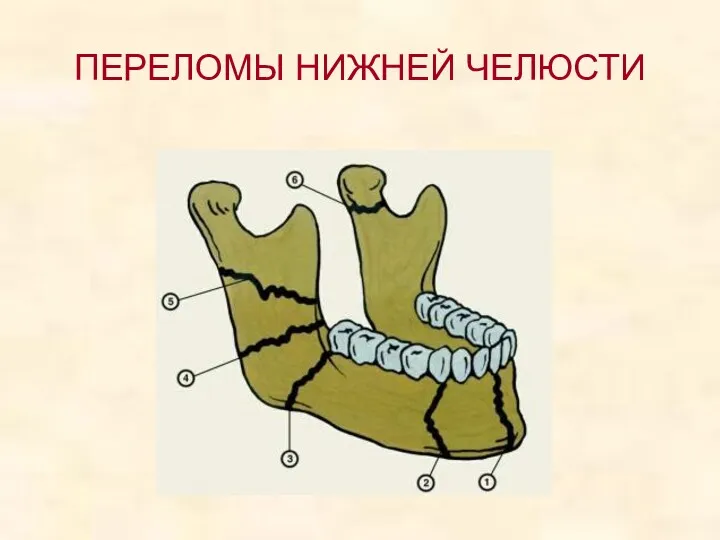 ПЕРЕЛОМЫ НИЖНЕЙ ЧЕЛЮСТИ