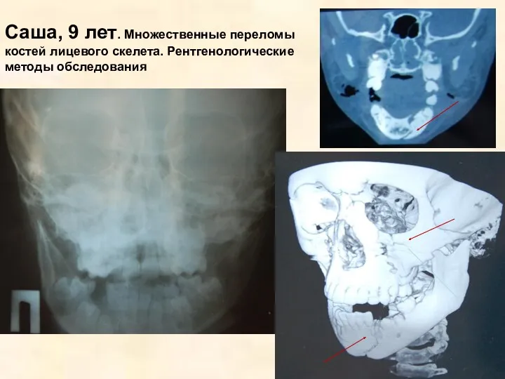 Саша, 9 лет. Множественные переломы костей лицевого скелета. Рентгенологические методы обследования