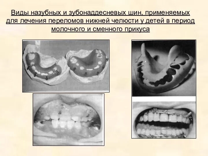 Виды назубных и зубонаддесневых шин, применяемых для лечения переломов нижней