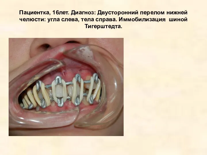 Пациентка, 16лет. Диагноз: Двусторонний перелом нижней челюсти: угла слева, тела справа. Иммобилизация шиной Тигерштедта.