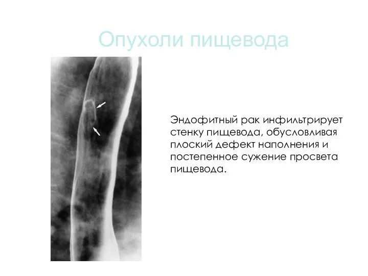 Опухоли пищевода Эндофитный рак инфильтрирует стенку пищевода, обусловливая плоский дефект наполнения и постепенное сужение просвета пищевода.