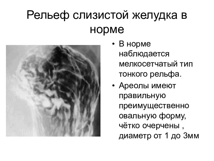 Рельеф слизистой желудка в норме В норме наблюдается мелкосетчатый тип