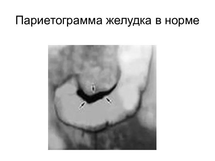 Париетограмма желудка в норме