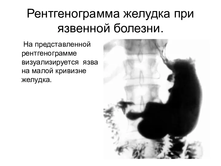Рентгенограмма желудка при язвенной болезни. На представленной рентгенограмме визуализируется язва на малой кривизне желудка.