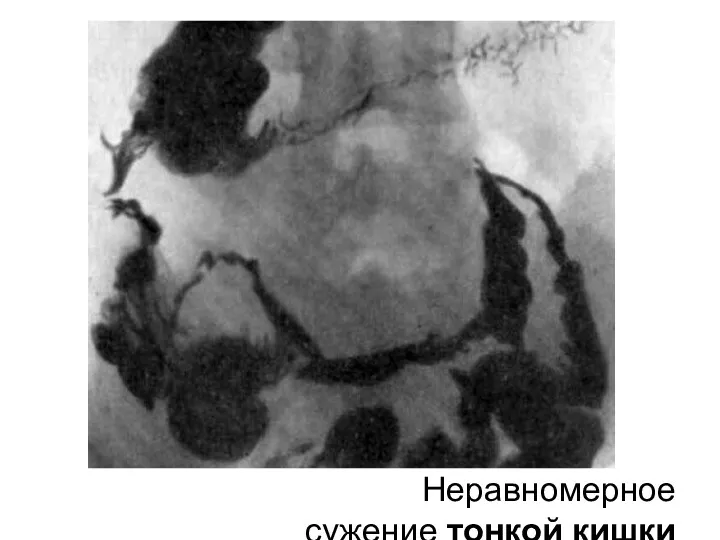 Неравномерное сужение тонкой кишки