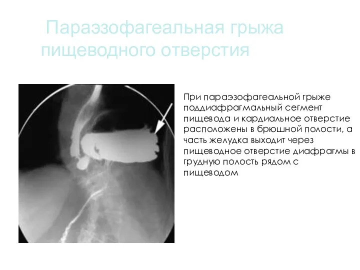 Параэзофагеальная грыжа пищеводного отверстия При параэзофагеальной грыже поддиафрагмальный сегмент пищевода