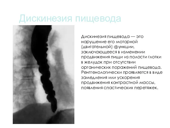 Дискинезия пищевода Дискинезия пищевода — это нарушение его моторной (двигательной)