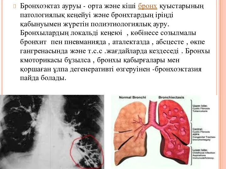 Бронхоэктаз ауруы - орта және кіші бронх қуыстарының патологиялық кеңейуі