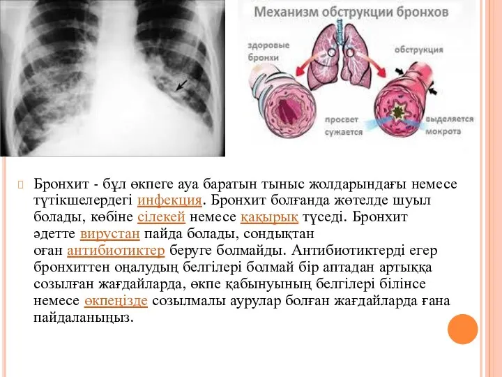 Бронхит - бұл өкпеге ауа баратын тыныс жолдарындағы немесе түтікшелердегі