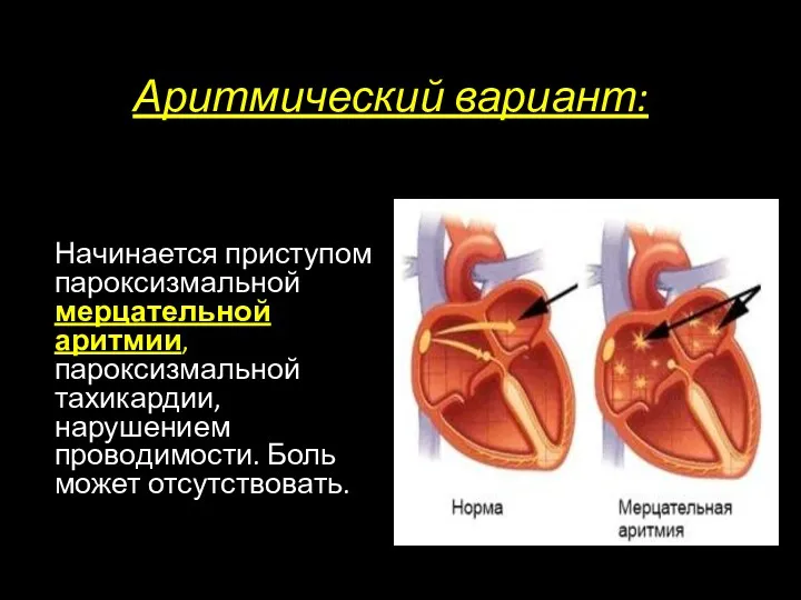 Аритмический вариант: Начинается приступом пароксизмальной мерцательной аритмии, пароксизмальной тахикардии, нарушением проводимости. Боль может отсутствовать.