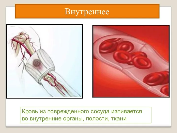 Кровь из поврежденного сосуда изливается во внутренние органы, полости, ткани Внутреннее