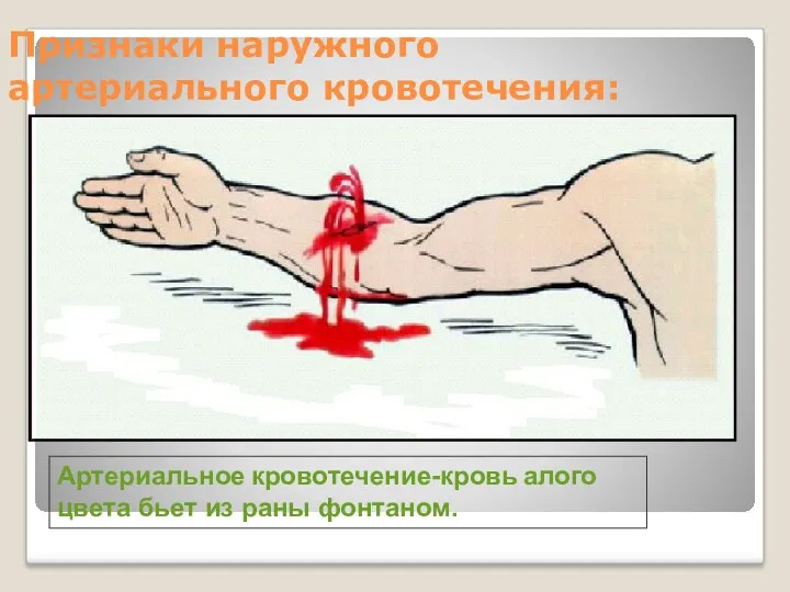 Артериальное кровотечение-кровь алого цвета бьет из раны фонтаном. Признаки наружного артериального кровотечения: