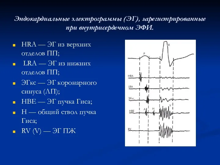 Эндокардиальные электрограммы (ЭГ), зарегистрированные при внутрисердечном ЭФИ. HRA — ЭГ