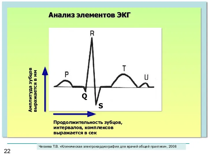 Анализ элементов ЭКГ Амплитуда зубцов выражается в мм Продолжительность зубцов,