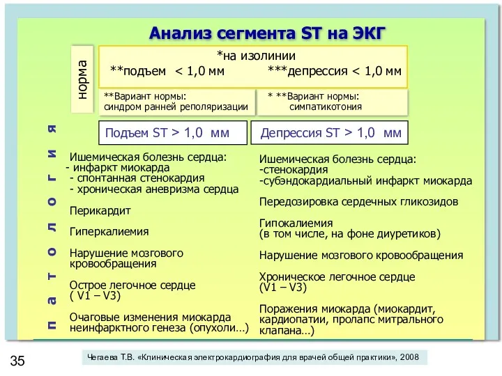 Анализ сегмента SТ на ЭКГ Подъем ST > 1,0 мм