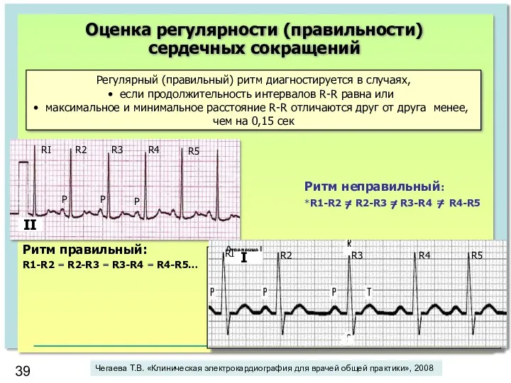 Оценка регулярности (правильности) сердечных сокращений Регулярный (правильный) ритм диагностируется в