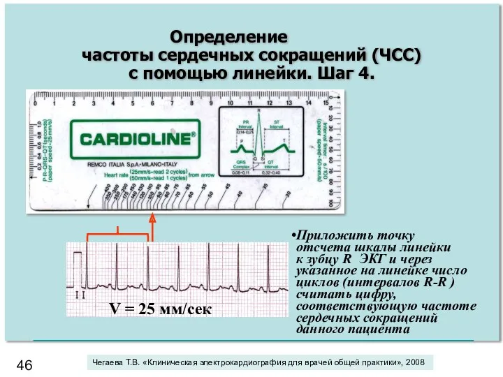 Приложить точку отсчета шкалы линейки к зубцу R ЭКГ и