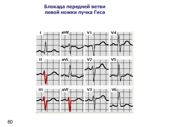 Блокада передней ветви левой ножки пучка Гиса 60