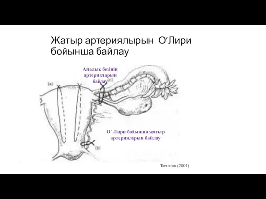 Жатыр артериялырын О’Лири бойынша байлау Tamizian (2001) О´ Лири бойынша