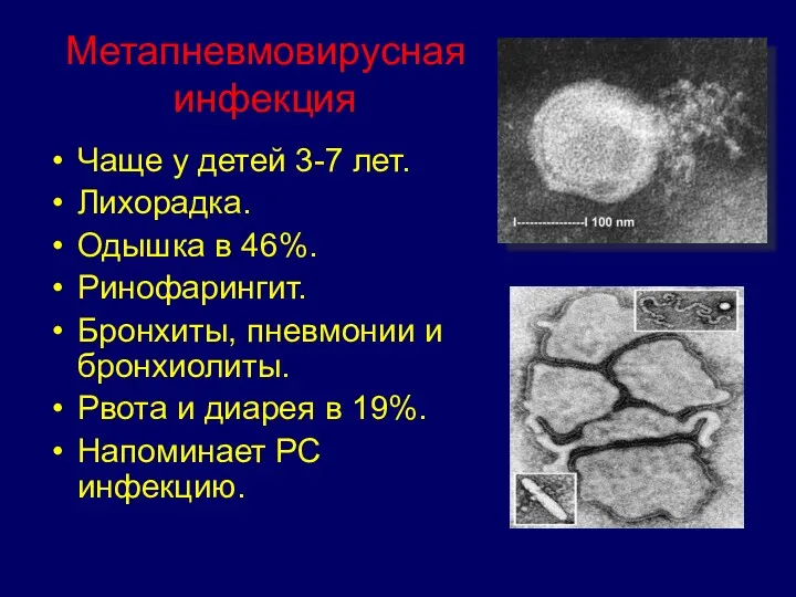 Метапневмовирусная инфекция Чаще у детей 3-7 лет. Лихорадка. Одышка в 46%. Ринофарингит. Бронхиты,