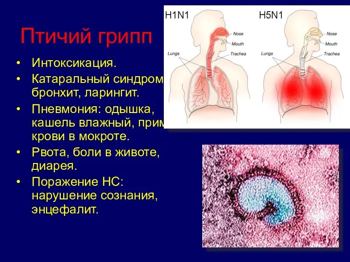 Птичий грипп Интоксикация. Катаральный синдром: бронхит, ларингит. Пневмония: одышка, кашель влажный, примесь крови