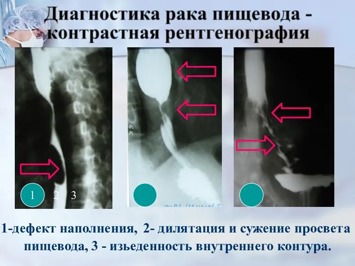 1 2 3 1-дефект наполнения, 2- дилятация и сужение просвета пищевода, 3 - изьеденность внутреннего контура.