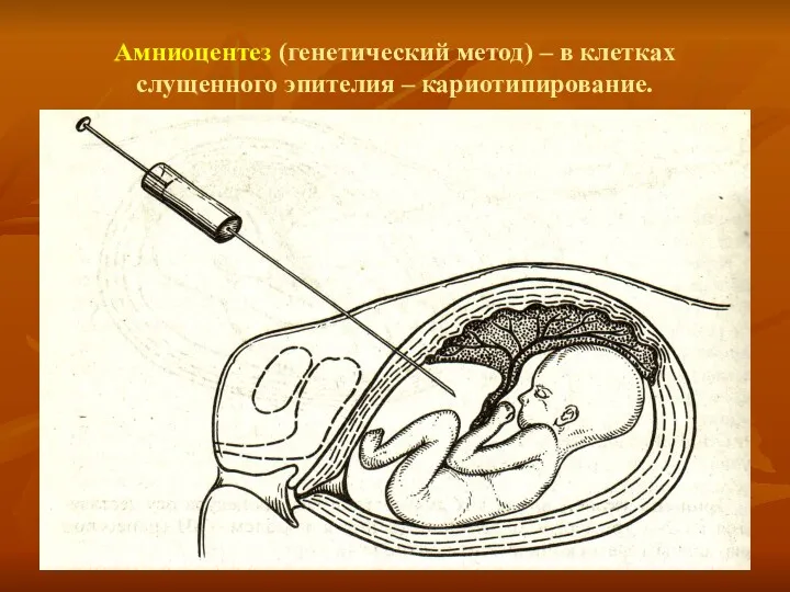 Амниоцентез (генетический метод) – в клетках слущенного эпителия – кариотипирование.