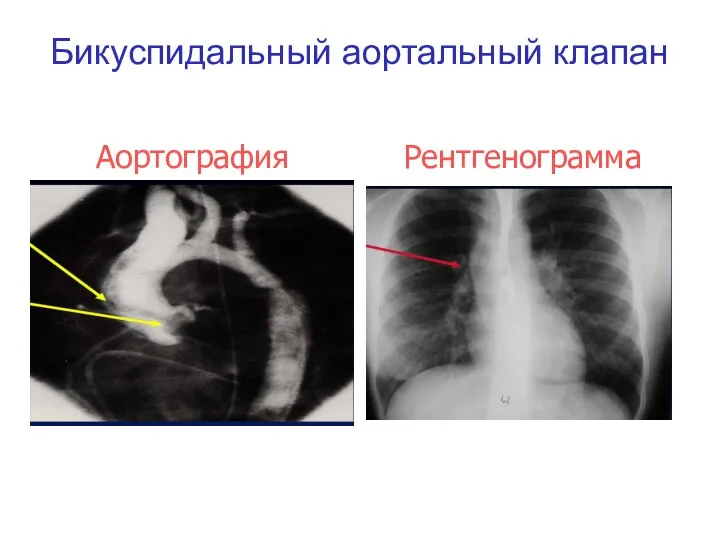 Бикуспидальный аортальный клапан Аортография Рентгенограмма