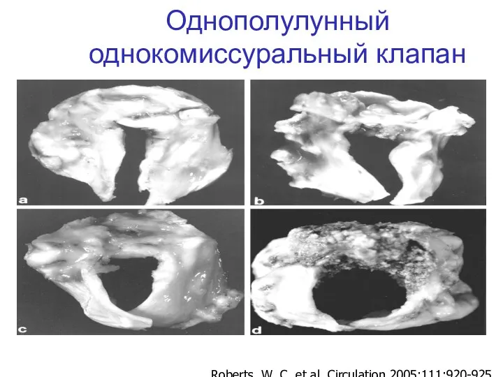 Roberts, W. C. et al. Circulation 2005;111:920-925 Однополулунный однокомиссуральный клапан