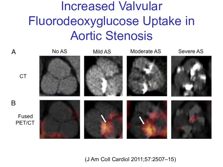 Increased Valvular Fluorodeoxyglucose Uptake in Aortic Stenosis (J Am Coll Cardiol 2011;57:2507–15)