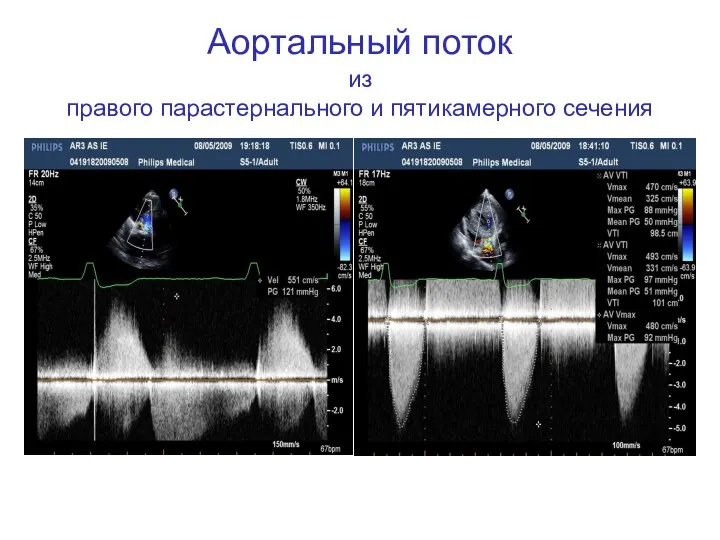 Аортальный поток из правого парастернального и пятикамерного сечения