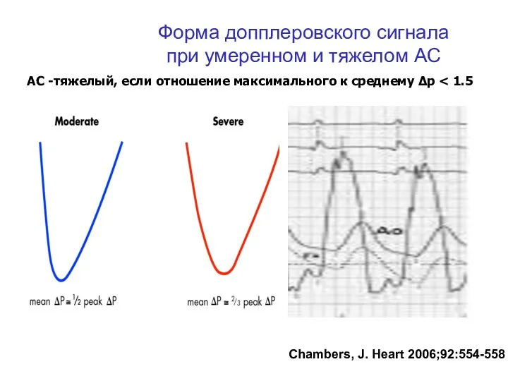 Chambers, J. Heart 2006;92:554-558 Форма допплеровского сигнала при умеренном и