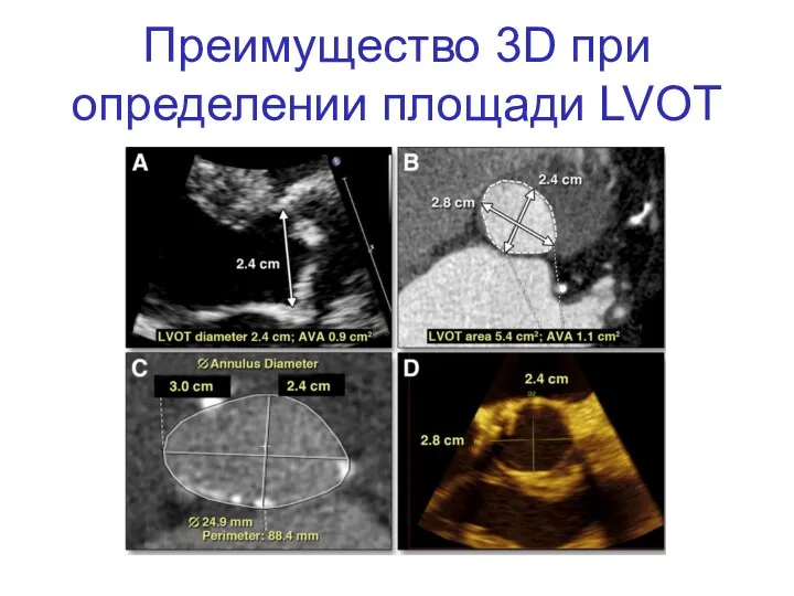 Преимущество 3D при определении площади LVOT
