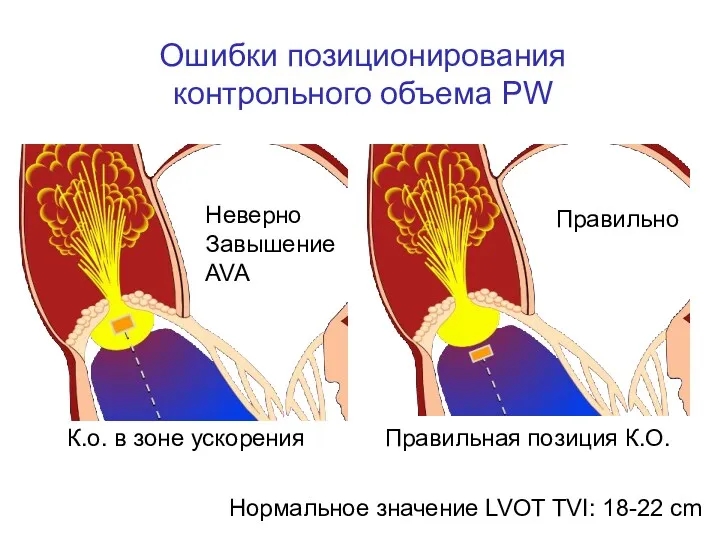 К.о. в зоне ускорения Правильная позиция К.О. Ошибки позиционирования контрольного