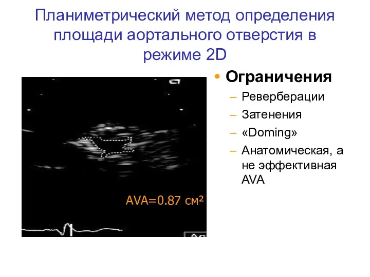 Планиметрический метод определения площади аортального отверстия в режиме 2D Ограничения