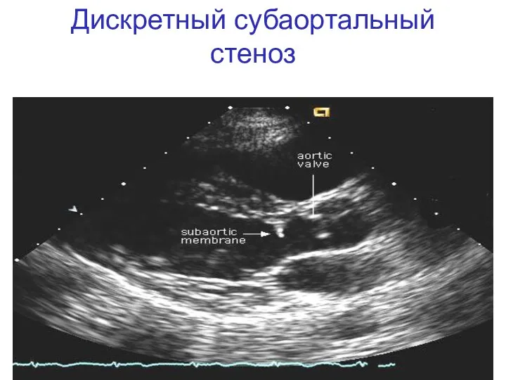 Дискретный субаортальный стеноз