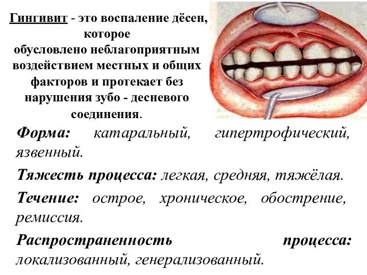 Гингивит - это воспаление дёсен, которое обусловлено неблагоприятным воздействием местных